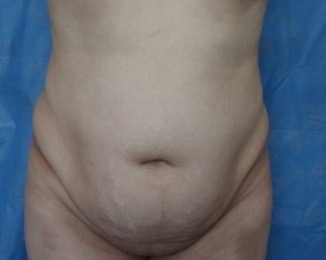 Abdomen-1